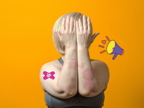 Femme avec un psoriasis